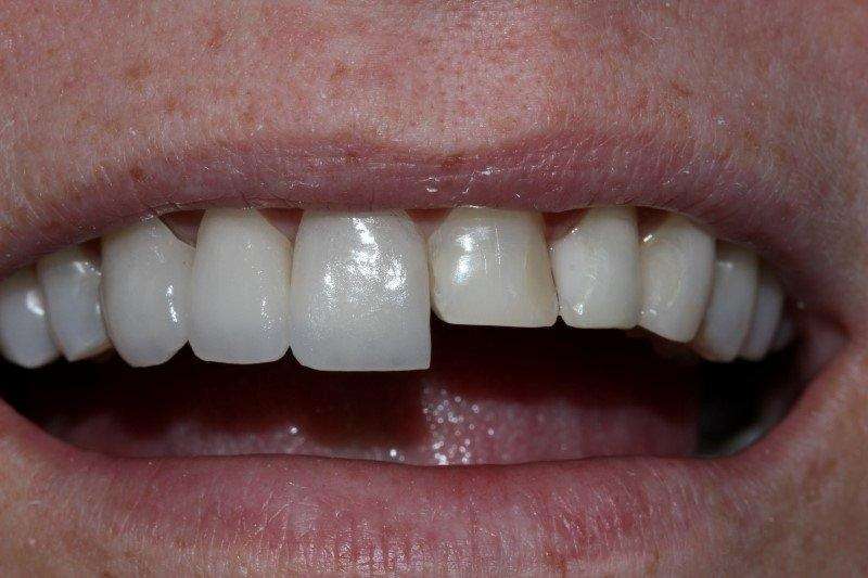 Lente De Contato Pros Dentes