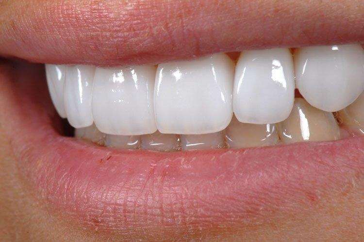 Placas De Porcelana Para Dentes