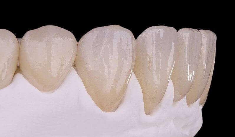 Prótese Fixa Dentária