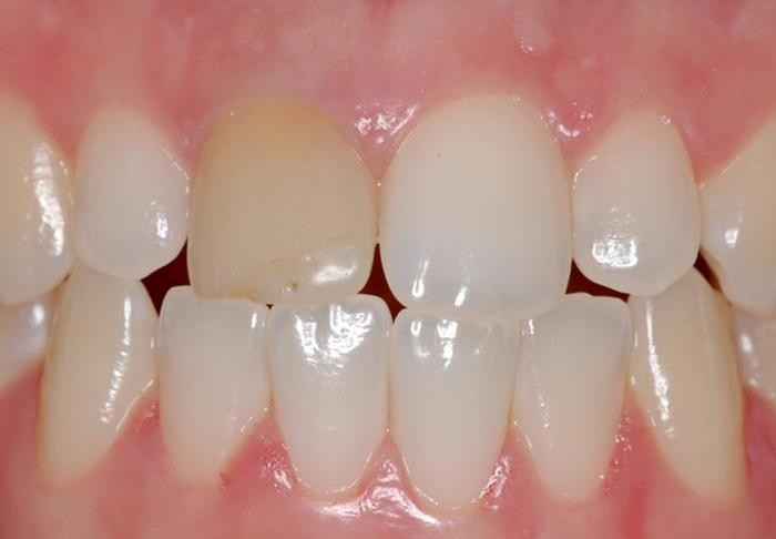 Tratamento De Canal No Dente